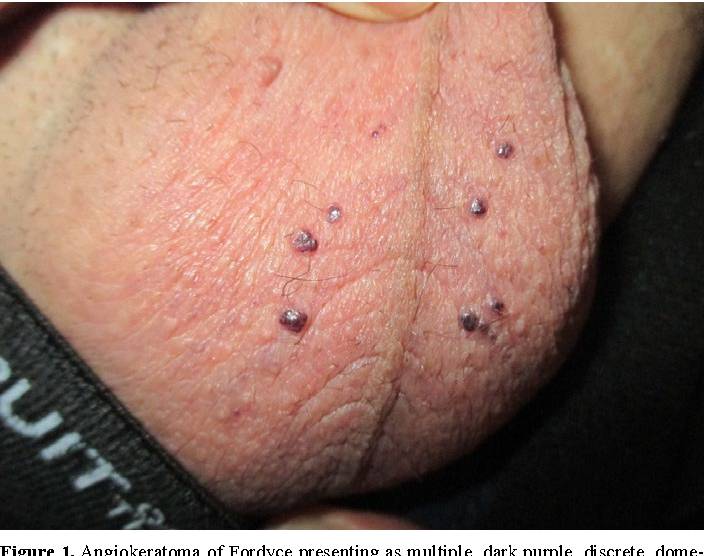 عکس بیماریهای پوستی دستگاه تناسلی مردان 