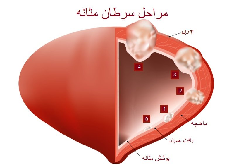 مراحل سرطان مثانه