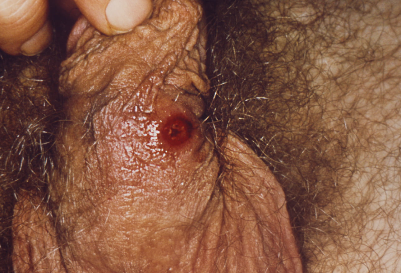 сифилисом можно заразится от мастурбации фото 1