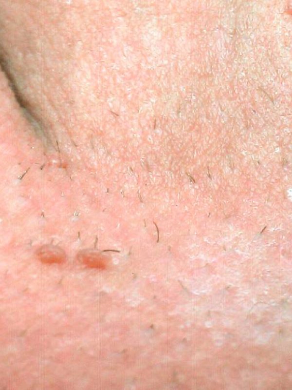 The difference between pimples and genital warts .