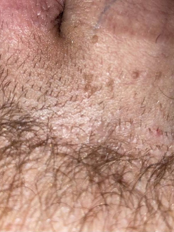 pimples and genital warts